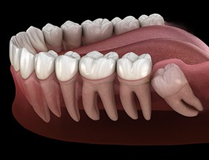 Image of an impacted wisdom tooth