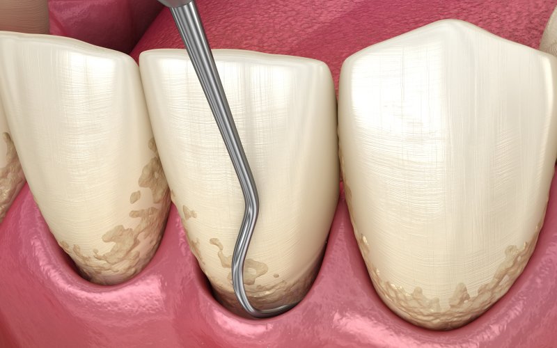 Illustration of gums receiving periodontal therapy